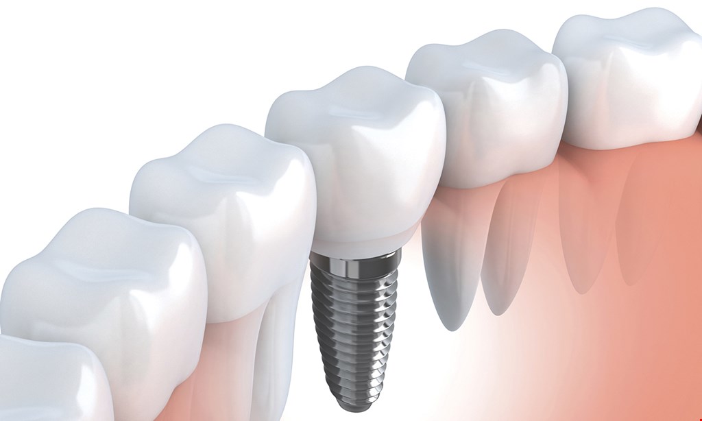 Product image for Governor Dental Free dental implant consultation. 