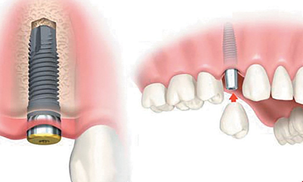 Product image for Dr. Parul Mehta & Associates $249 regular $349 laser teeth whitening. 