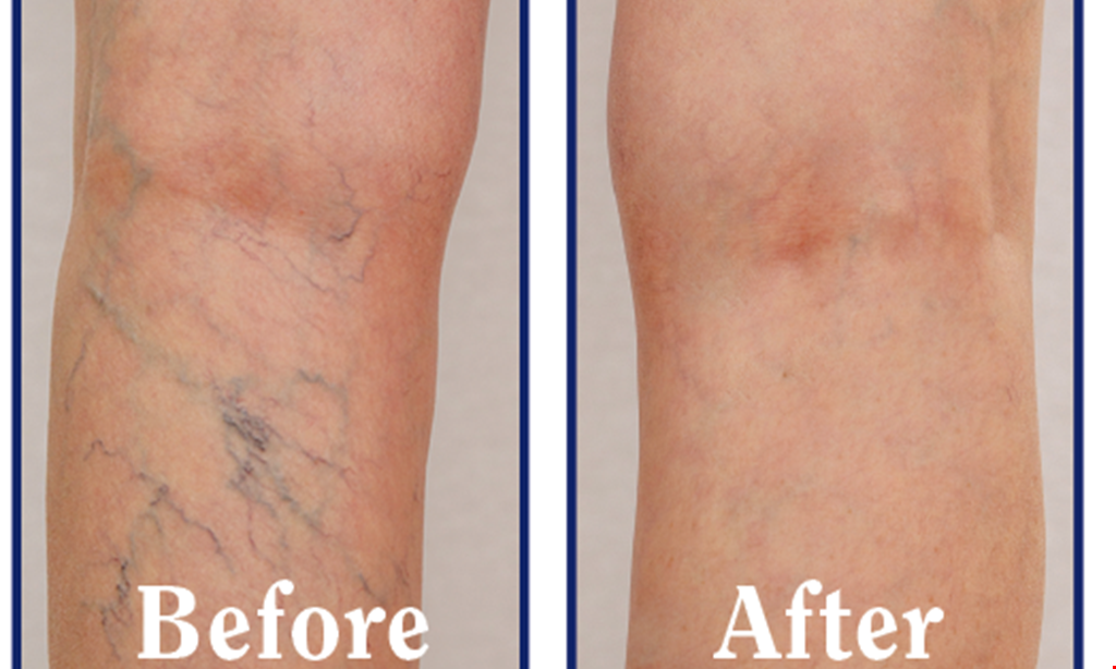 Product image for Jacksonville Vein Specialists - Atlantic Blvd FREE Vein Screeningwith Physician