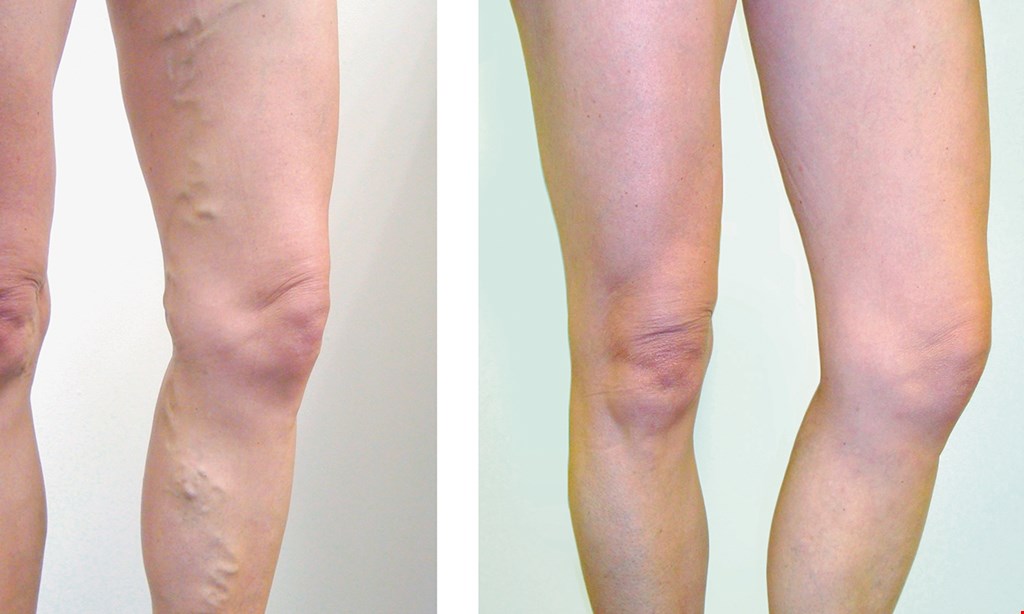 Product image for Thunderbird Vein COMPLIMENTARY Compression Stockings With Varicose Vein Treatment