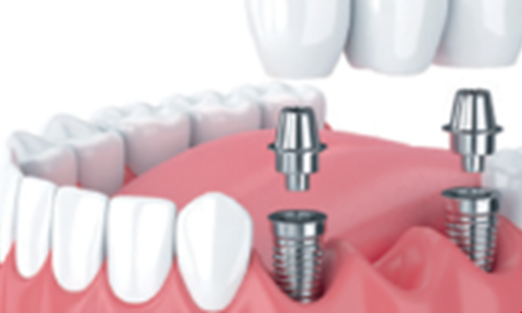 Product image for Omnia Dental $500 OFF Dental Implants