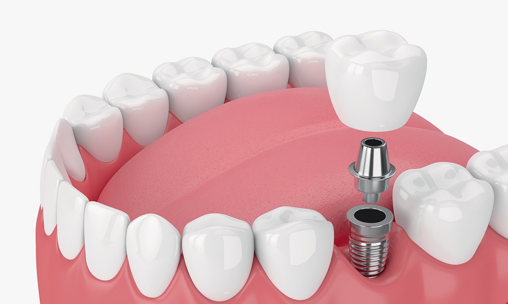 Product image for The Dental Place Of Tamarac Free dental implant consultation.