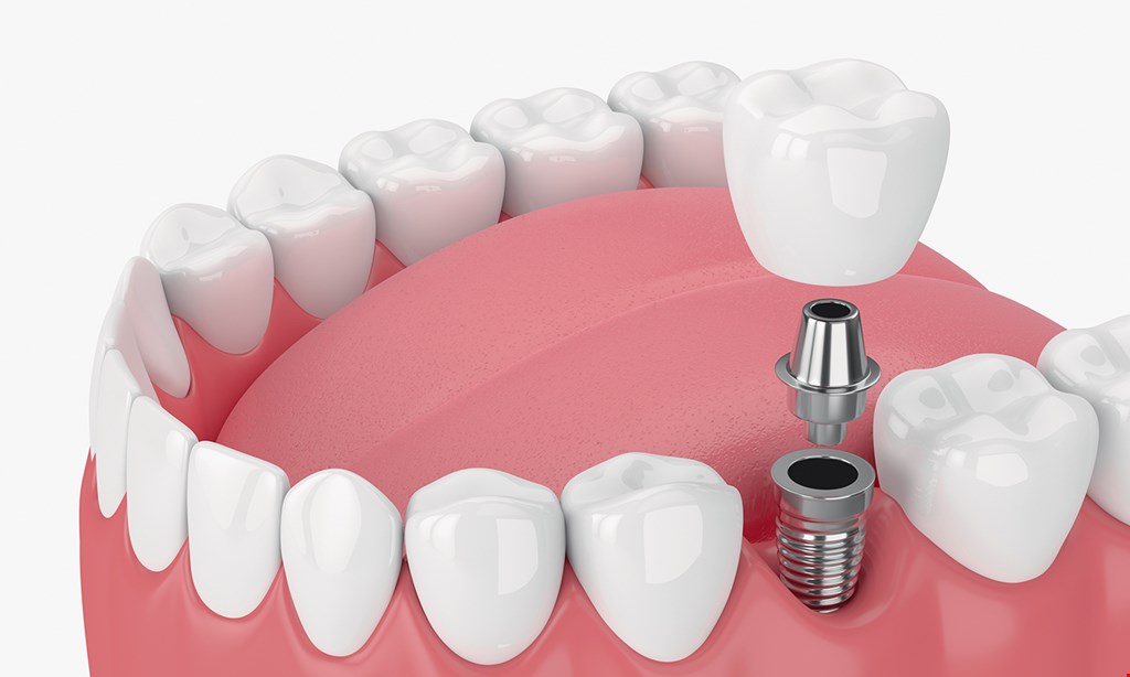 Product image for The Dental Place Of Oakland Park Free dental implant consultation D6010.