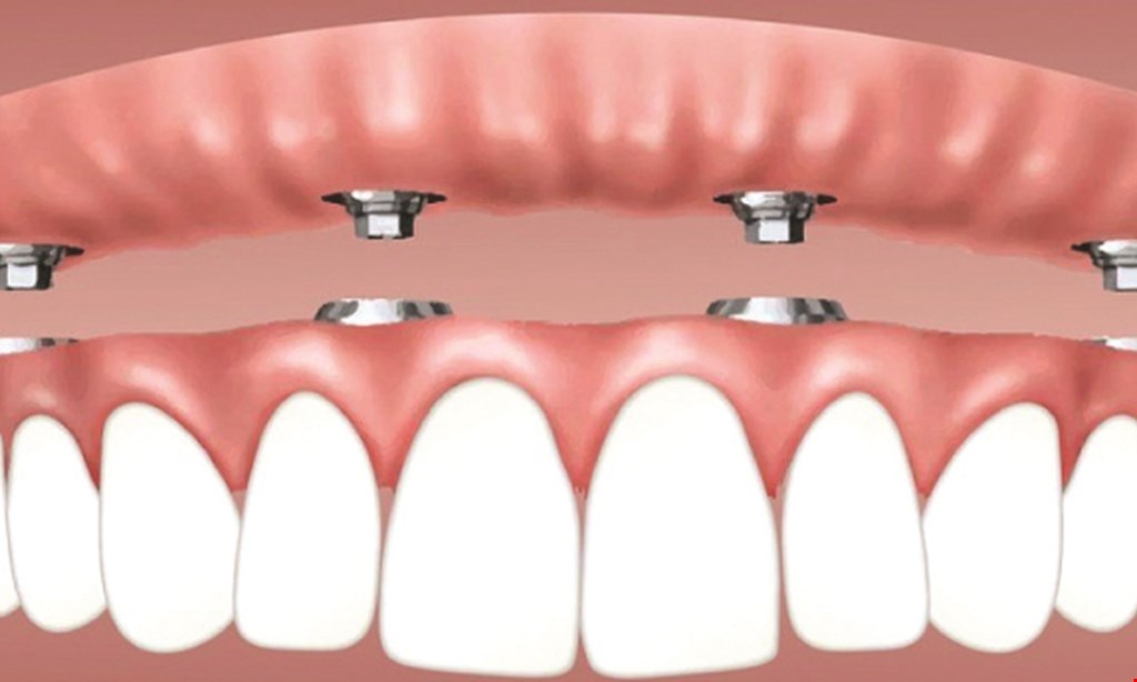 Product image for Legacy Dental Of Temecula Single dental implant $2,499