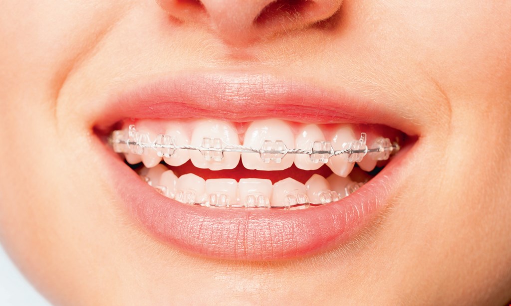 Product image for Champion Orthodontics $1500 OFF New Patient Special