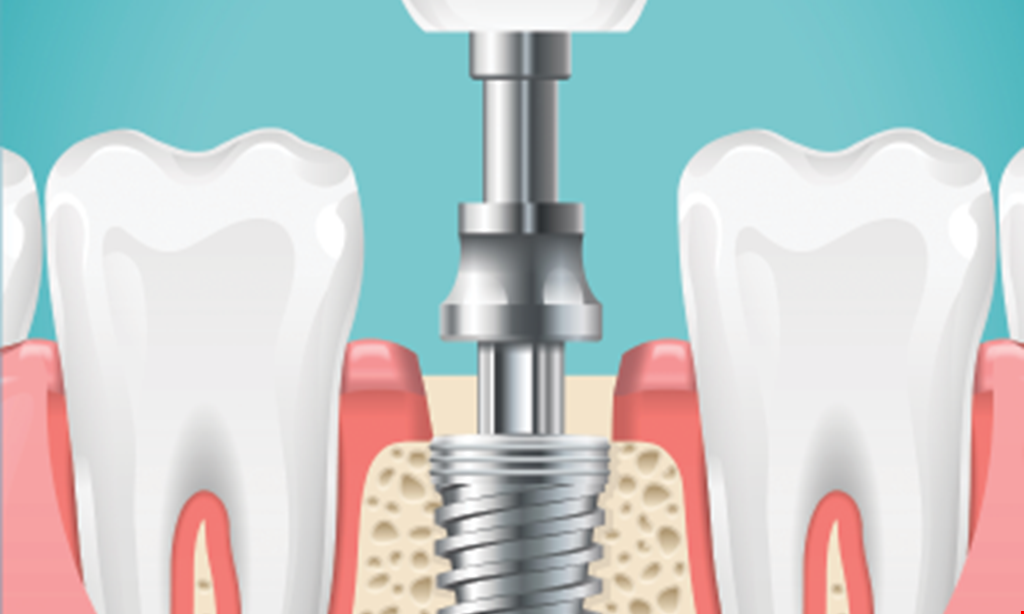 Product image for Dice Dental $1250 implant placement, abutment and crown.
