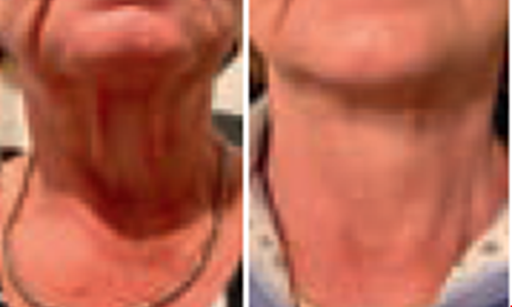 Product image for Coast To Coast- Sanford $549 for RF micro-needling of face, neck or chest.