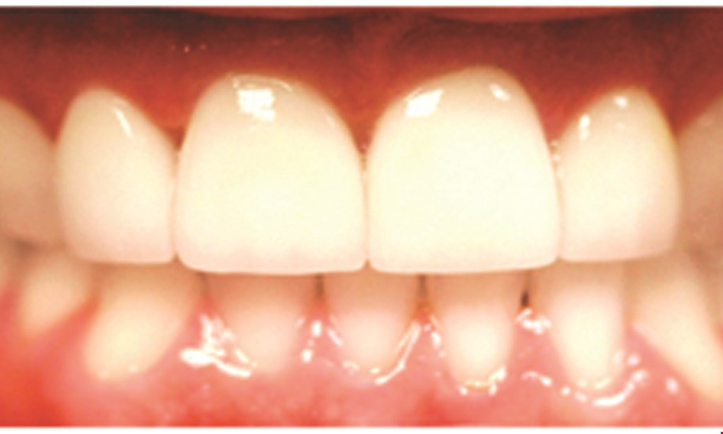 Product image for Dr. Jose J. Alvarez & Associates Advanced Implant & Smile Design Dentistry. One-Visit Composite Veneers "Instant Smile Makeover" $499 per tooth 