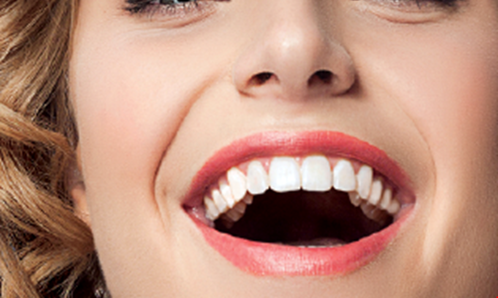 Product image for Smile Design Free teeth whitening.