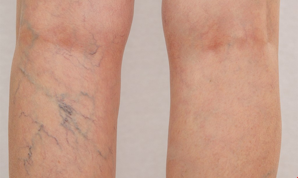 Product image for Jacksonville Vein Specialists $74.50 for one 20-minute Sclerotherapy Vein Session ($200 value)