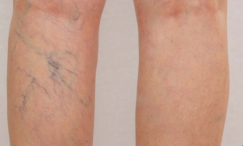 Product image for Jacksonville Vein Specialists - Atlantic Blvd $74.50 for one 20-minute Sclerotherapy Vein Session ($200 value)