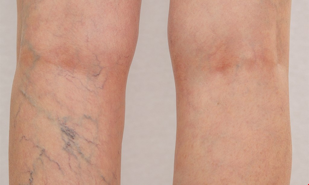 Product image for Palm Coast Vein Specialists $74.50 for one 20-minute Sclerotherapy Vein Session ($200 value)